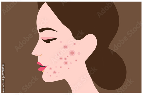 Young woman face with skin acne, pimples, blackheads vector illustration. Acne skin face problem concept