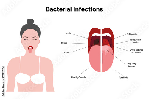 Woman with open mouth, viral bacterial infection, sore throat, tonsillitis, and healthy tonsils medical diagram 