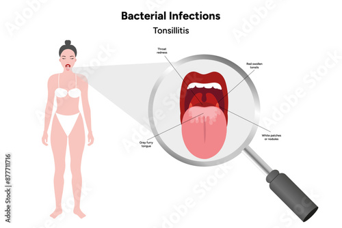 Woman with open mouth, viral bacterial infection, sore throat, tonsillitis, medical diagram 