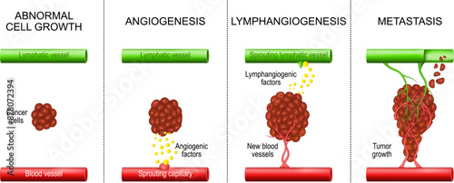 Cancer. Tumor development. Angiogenesis and Metastasis.