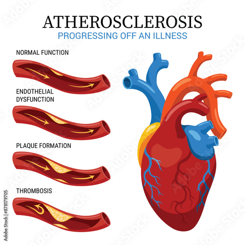 Atherosclerosis stages. Anatomy of heart attack. Arteriosclerotic vascular disease or ASVD. Atherosclerotic plaque in coronary artery. Vector illustration on white background