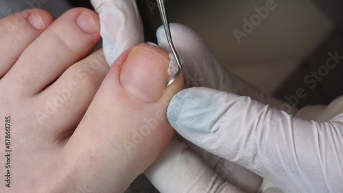 Medical pedicure, podiatrist doing tamponade to a deformed toenail photo