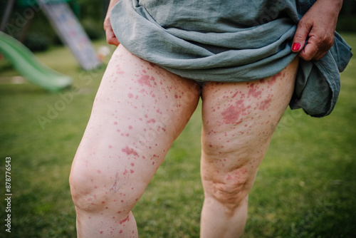 Close-up of a woman's legs showing a skin rash caused by Human Parvovirus (Parvovirus B19), standing in a grassy area. photo