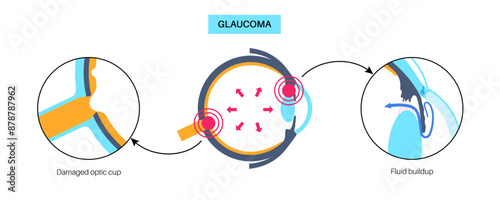 Glaucoma eye disease