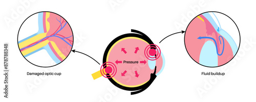 Glaucoma eye disease