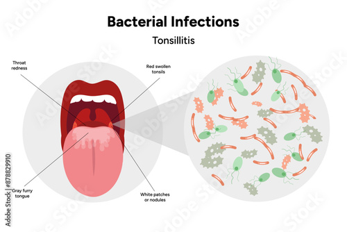 Bacterial infection tonsillitis 