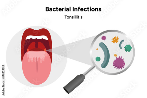 Bacterial infection tonsillitis 