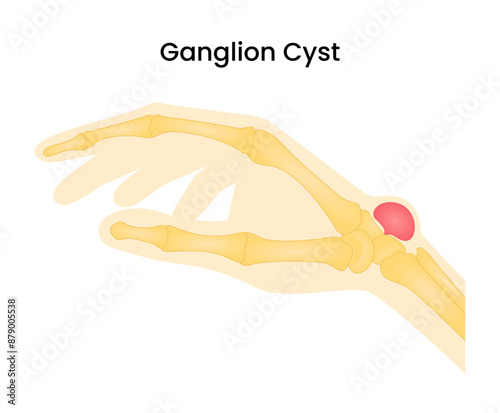 Ganglion Cyst on the Wrist