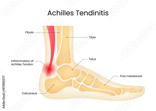 Achilles Tendinitis Symptoms Diagram