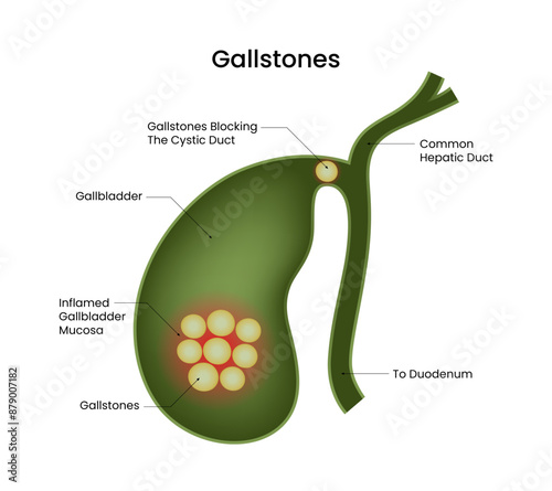 Gallstone Diagram Inflamed Gallbladder Mucosa
