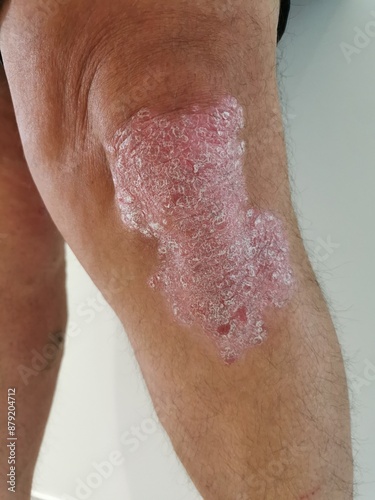 Fotografie Psoriasis sur genou