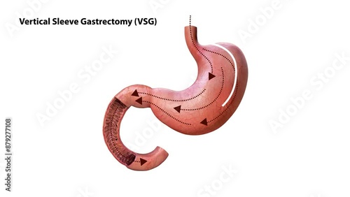 Laparoscopic Sleeve Gastrectomy Logo, Vertical Gastrectomy Logo , Weight loss surgery 3d animation of Stomach reduction logo surgery, vertical photo