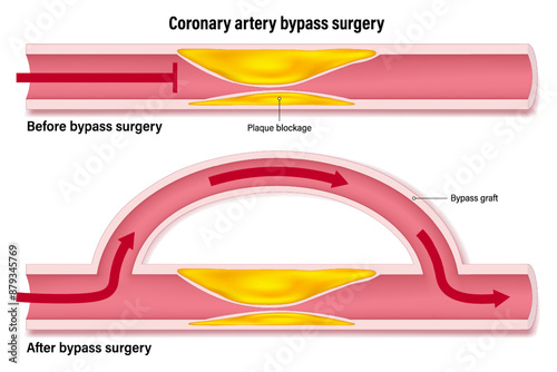Coronary artery bypass of the human heart. Blood vessels that have accumulated fat causing blockage of plaque and blood vessels after bypass surgery.