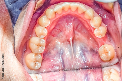 Occlusal view of a mandible arch, tongue retracted, saliva shining reflecting lights on sublingual floor, healthy teeth. Indirect view with dental mirror, lips retracted with plastic cheek retractor. photo