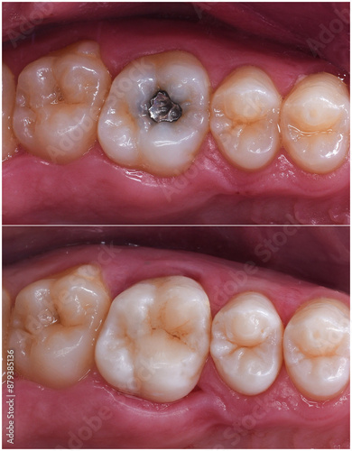 amalgam filling safe repacment with light cure esthetic composite filling