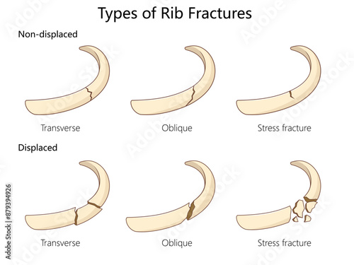 types of rib fractures, non-displaced and displaced fractures, transverse, oblique, stress fracture examples diagram hand drawn schematic vector illustration. Medical science educational illustration