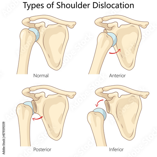 types of shoulder dislocation, normal, anterior, posterior, inferior dislocations, positions of humeral head diagram hand drawn schematic vector illustration. Medical science educational illustration