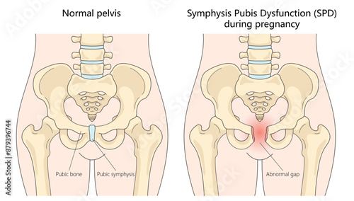 normal pelvis and affected by Symphysis Pubis Dysfunction during pregnancy, diagram hand drawn schematic vector illustration. Medical science educational illustration