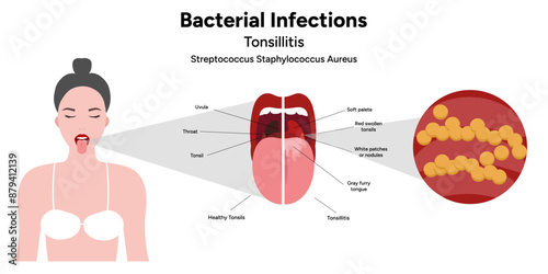 Bacterial infection tonsillitis 