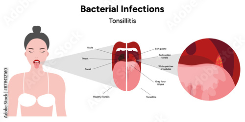 Bacterial infection tonsillitis 