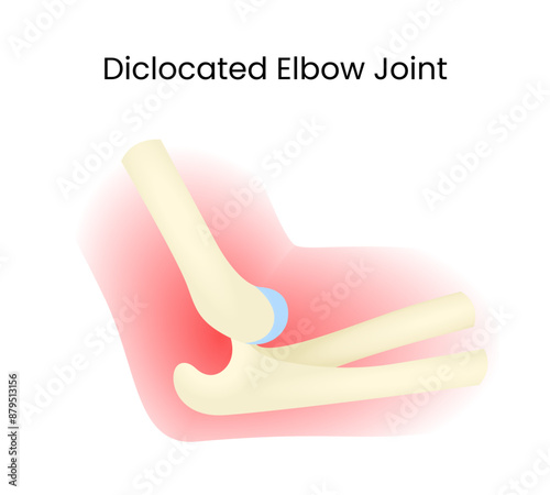 Dislocated Elbow Joint Vector Design