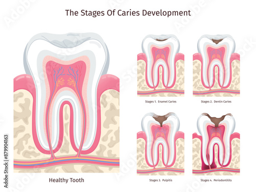 Caries stages. Human decay teeth progress, dental problem oral cavity gum infection abscess pulpitis dead tooth root canal disease periodontal erosion, swanky illustration