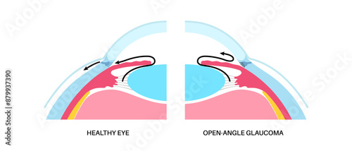 Glaucoma eye disease