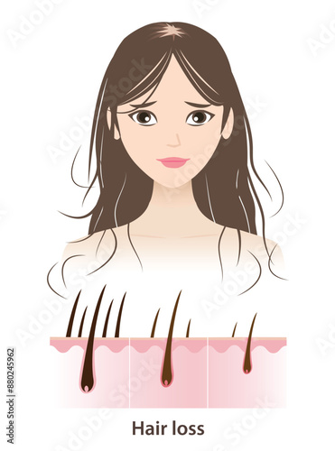 The woman with hair loss vector illustration on white background. Step of hair losing with scalp layer. Reduce, decrease, thin, remove, fall hair to alopecia, baldness and hairless. Hair care concept.
