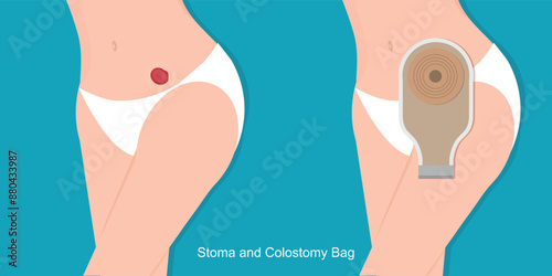 A colostomy in female is a surgical procedure.