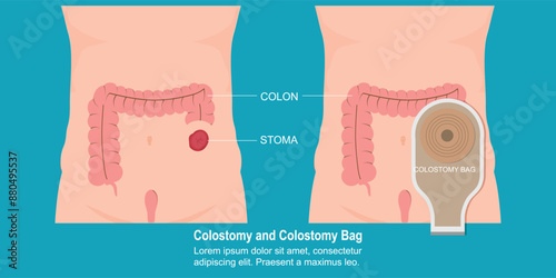 Colostomy and colostomy bag.