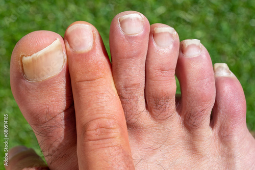 Set of the 5 toes of the right foot of human being on a green background. Index finger of the hand between the toes. photo