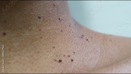 Close up the skin tags on woman's neck. Acrochordon. Health care concept. Woman showing her neck's skin with skin tag. photo