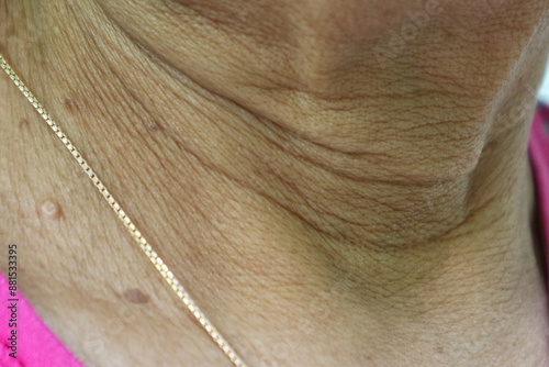 Aging skin folds or skin creases or wrinkles at neck of Southeast Asian, Indonesian old woman. Skin tags. photo