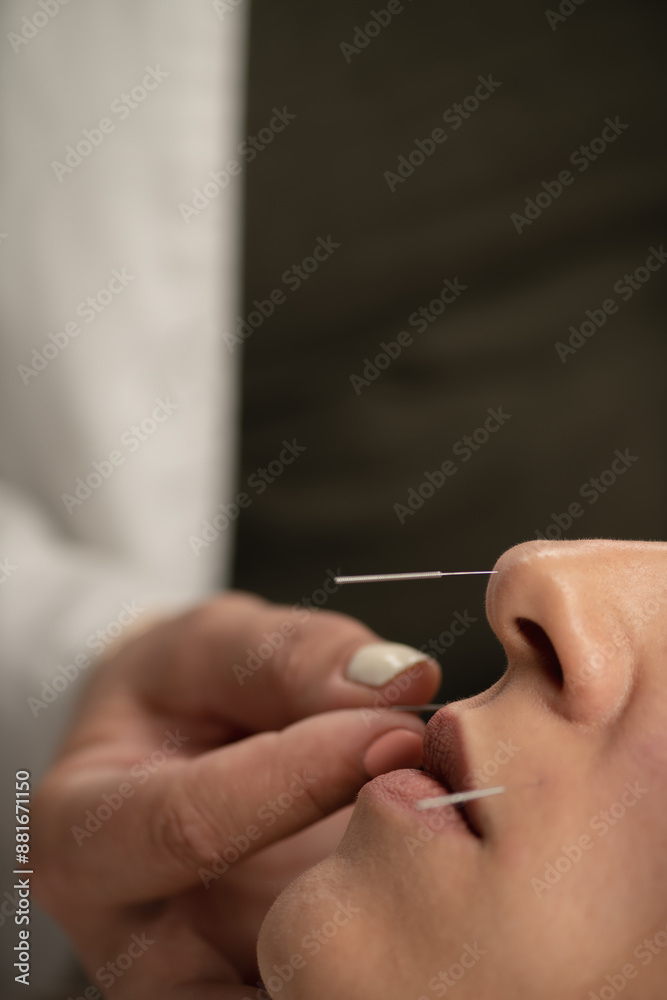 Acupuncturist inserting acupuncture needles into female patient nose to help quit smoking Acupuncturist inserting acupuncture needles into female patient nose to help quit smoking