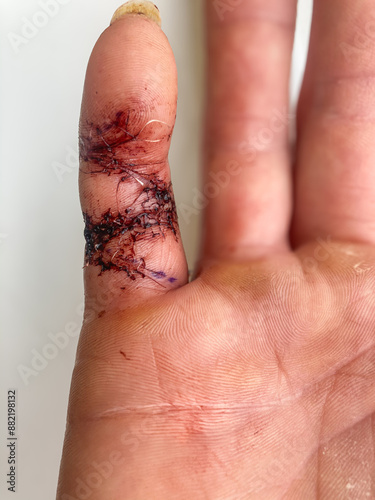 Fotografía Three Days Post-Operation: Severed Little Finger Flexor Tendon