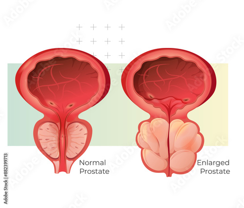 Normal Prostate and Enlarged Prostate Gland under Bladder - Stock Illustration