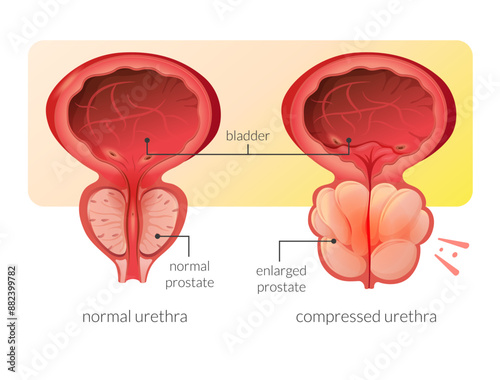 Normal Prostate and Enlarged Prostate Gland under Bladder - Stock Illustration photo