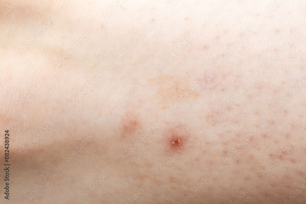 Close up of skin showing signs of chickenpox virus Close up of skin showing signs of chickenpox virus