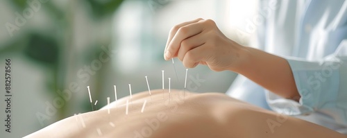 Acupuncturist inserting needles into a patient's back, acupuncture treatment, traditional healing photo