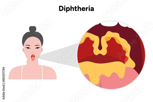 Diphtheria woman open mouth with throat zoom