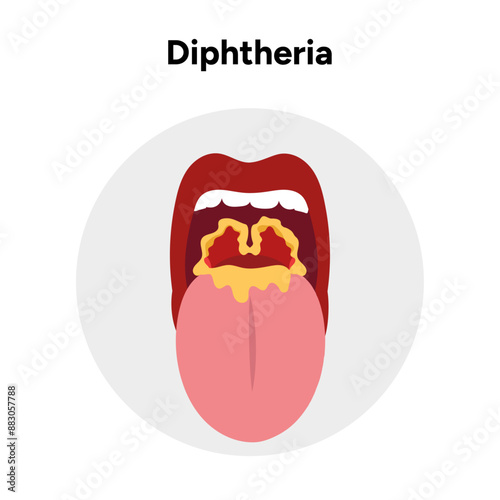 Diphtheria open mouth throat zoom