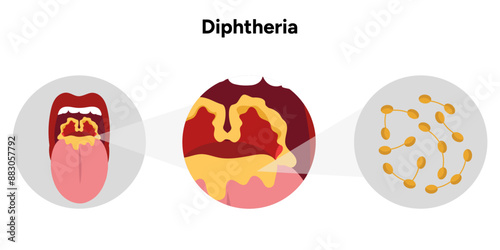Diphtheria open mouth illustration with throat zoom and bacterial zoom