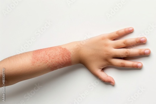Children's hand with atopic dermatitis
Dermatitis, diathesis, allergy on the child's body.	