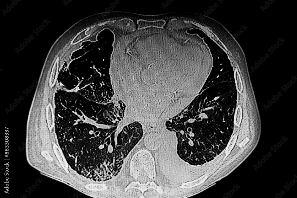 Medical themes: CAT Chest. Bilateral reticular infiltrate and pericardial effusion