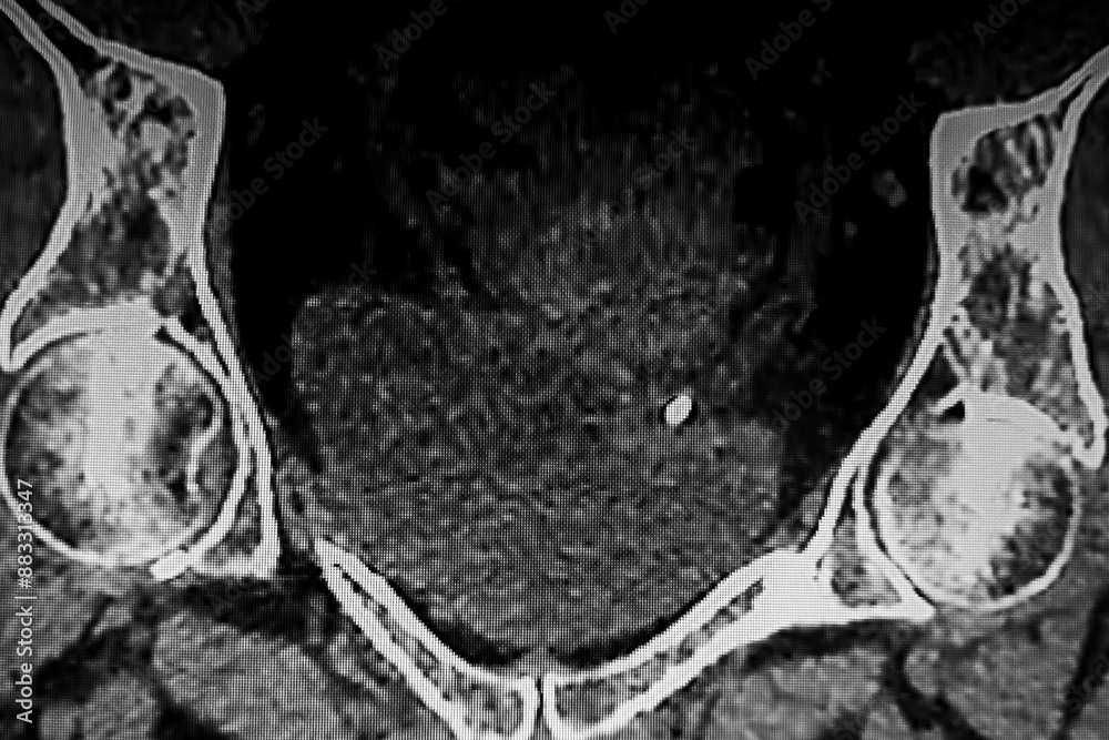 Medical themes: Abdominal tomography showing bilateral renal lithiasis. Bilateral hydronephrosis