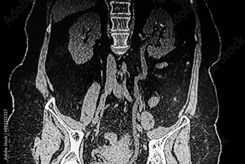 Obraz na płótnie Medical themes: Abdominal tomography showing bilateral renal lithiasis. Bilateral hydronephrosis w salonie