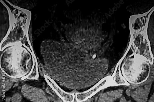 Obraz na płótnie Medical themes: Abdominal tomography showing bilateral renal lithiasis. Bilateral hydronephrosis w salonie