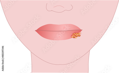 Lips virus cold sore infected, herpes simplex virus type, HSV 1. Contagious wound anatomy, diagram skin side view. Facial, mouth, oral skin problem. Dermatology, medical. Vector illustration