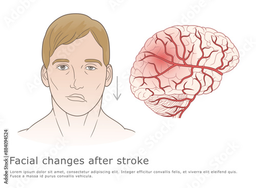 Facial changes after Stroke vector medical illustration. 