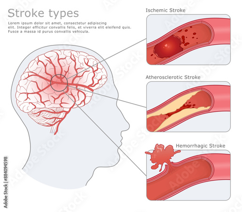 Damaged human brain after a Stroke and three types of Stroke. Vector medical illustration.